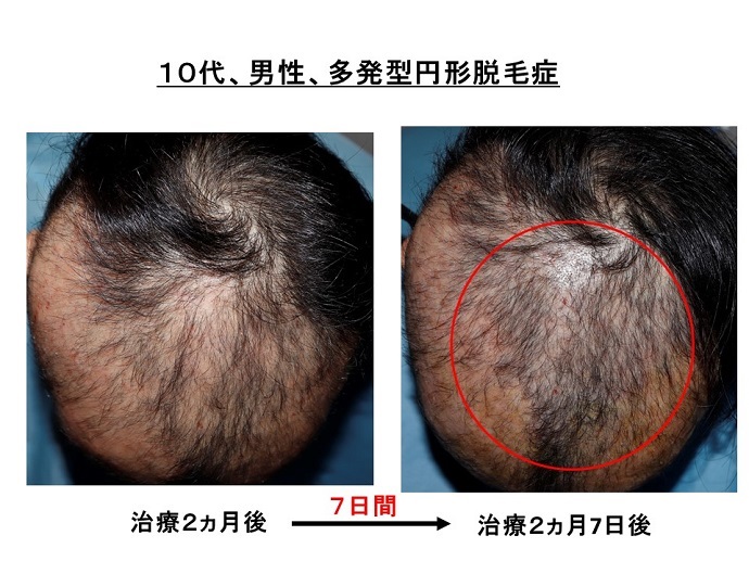 円形脱毛症　病院